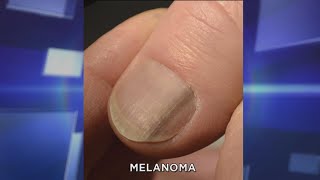 Subungual Melanoma What You Need to Know [upl. by Ax]