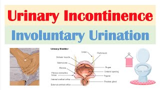 Urinary Incontinence Stress Urge Overflow amp Functional  Causes Symptoms Diagnosis Treatment [upl. by Llehsyar]