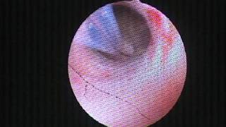 Loop biopsy for suspected endometrial cancer Hysteroscopy [upl. by Nothgiel]