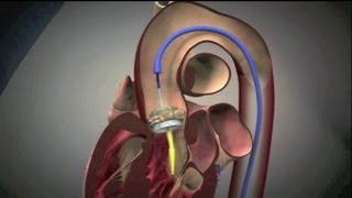 Transcatheter Aortic Valve Implantation TAVI [upl. by Arne32]