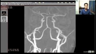 Angiogram  BRAIN angio procedure video [upl. by Junji]