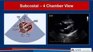 Guidelines for Performing a Comprehensive TTE in Adults Webinar [upl. by Hpesoj326]