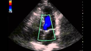 Echo Appearance of Aortic Regurgitation or Insufficiency [upl. by Eloccin]