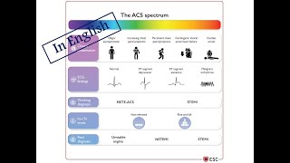 1 Diagnosis amp Triage of ACS English Version [upl. by Xuerd578]