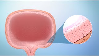 Managing Renal Pelvis Transitional Cell Carcinoma [upl. by Stephenie800]