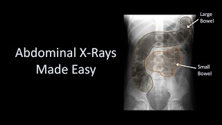 Abdominal XRays Made Easy [upl. by Enirehtak718]