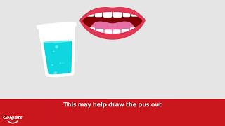 How To Treat a Gum or Tooth Abscess  Colgate® [upl. by Asiilanna]