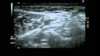 Posterior Tibial Nerve Block Ultrasound guided [upl. by Narda880]