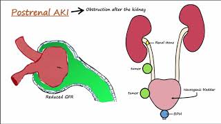 Acute Kidney Injury AKI  PrerenalIntrarenalPostrenal [upl. by Nylitsirk]