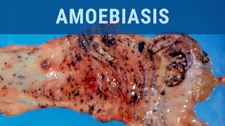 Amoebiasis  Pathology mini tutorial [upl. by Kean220]