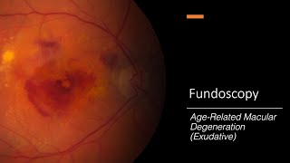 AgeRelated Macular Degeneration Exudative Fundoscopy [upl. by Gunnar]