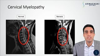 Cervical Myelopathy  What is it How can we treat it [upl. by Killigrew]