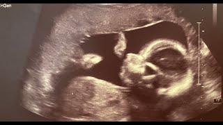 How to Perform 3D Scan of the Baby at 12 Weeks of Pregnancy [upl. by Kramnhoj]