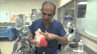 Heart Bypass Surgery Explained Part1  HDflv [upl. by Ainessej]