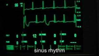 extrasystoles ventricular bigeminus [upl. by Alroy]