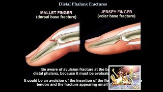 Distal Phalanx Fractures  Everything You Need To Know  Dr Nabil Ebraheim [upl. by Aizirk]