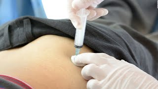 Painfree Intraarticular Injection of Knee [upl. by Eckmann]