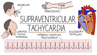 Understanding Supraventricular Tachycardia SVT [upl. by Rasaec507]