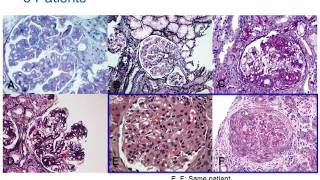 Rapidly Progressive Glomerulonephritis Pathology RPGN Pathology [upl. by Ahseen643]