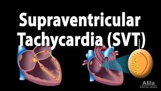 Supraventricular Tachycardia SVT PSVT Animation [upl. by Kciredohr159]