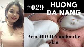 029 Acne HIDDEN under the skin  Acne treatment Hương Đà Nẵng Official [upl. by Longtin]