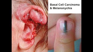 Basal Cell Carcinoma amp Melanonychia Nail Lines Updated [upl. by Roscoe]