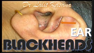 EAR COMEDONES by DrLalit Kasana [upl. by Zusman]