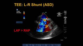 Using shunts in the Treatment of Spina Bifida [upl. by Inessa212]