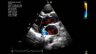 Echocardiographic assessment of the mitral valve [upl. by Chil]