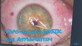 Contoura Vision Laser Eye Surgery for Astigmatism  Topographyguided LASIK PRK [upl. by Gildas]