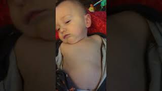 Example of Retractions Belly Breathing and Tachypnea in Infant [upl. by Ennasor]