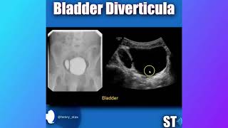 Bladder Diverticulum [upl. by Calica]