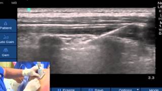 UltrasoundGuided Paravertebral Block [upl. by Halludba416]