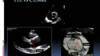 Echocardiographic assessment of bicuspid aortic valve [upl. by Nnyre]