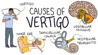 Vertigo Treatment  Epley Maneuver  American Academy of Neurology [upl. by Anhoj]