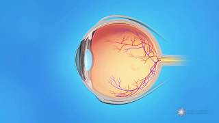 What is central retinal vein occlusion CRVO [upl. by Toolis58]