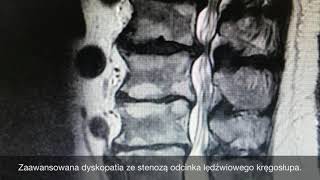 Dyskopatia i przepuklina krążka jak wyglądają na rezonansie magnetycznym [upl. by Dang]