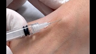 Petra Ganglion Wrist Cyst Aspiration [upl. by Cindelyn547]