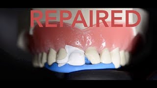 How the dentist repairs a chipped tooth [upl. by Cirdor]