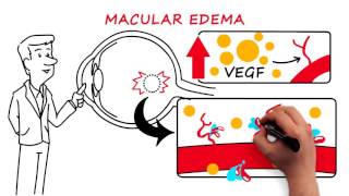 Retinal Vein Occlusion [upl. by Abbye]