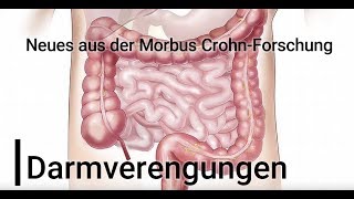 quotDarmverengungenquot  Neues aus der Morbus CrohnForschung [upl. by Pruchno133]