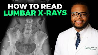 How to Read a Lumbar XRay [upl. by Aremmat]