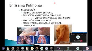 SEMIOLOGÍA 2  1ERA FASE  ENFISEMA PULMONAR Y SÍNDROME CAVITARIO [upl. by Huberty683]