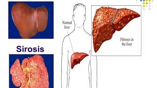 Asuhan Keperawatan Pasien Sirosis Hepatis [upl. by Adnarom]