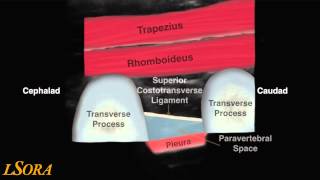 LSORA paravertebral block US guided tutorial [upl. by Ruamaj]