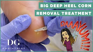 Big deep satisfying heel corn removal treatment on the foot  DG Podiatrist [upl. by Lauretta]