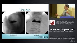 Video 4 Extrapedicular thoracic [upl. by Nadnal810]