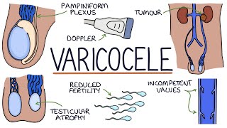 Varicocele Surgery What to Expect [upl. by Harrus840]