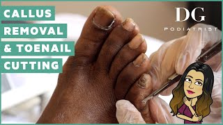 Callus removal and Toenail Cutting [upl. by Anifled88]