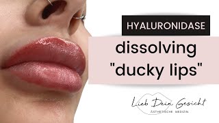 Dissolving Lip Filler [upl. by Zed]